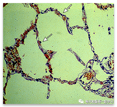 重症疾病之急性呼吸窘迫综合征（八）-ARDS的病理生理学