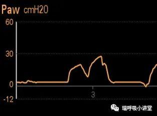 模式相关知识第二讲--肺泡压与跨肺压 模式相关知识第二讲--肺泡压与跨肺压