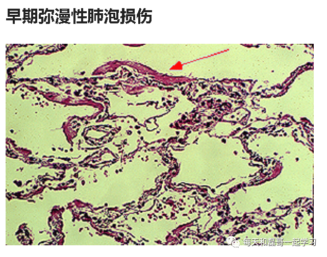 重症疾病之急性呼吸窘迫综合征(一)-ARDS的诊断 重症疾病之急性呼吸窘迫综合征(一)-ARDS的诊断