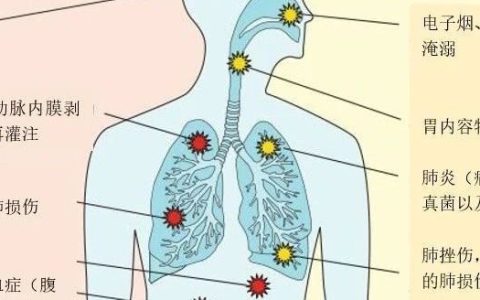 ARDS的诊断、病理生理学及治疗策略