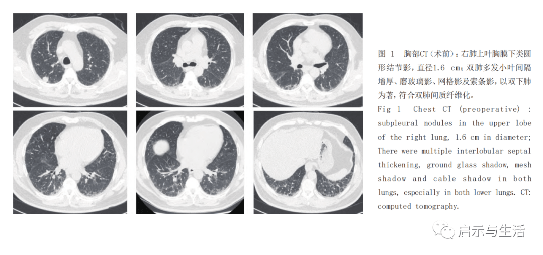 肺癌术后特发性肺纤维化急性加重抢救成功病例报道