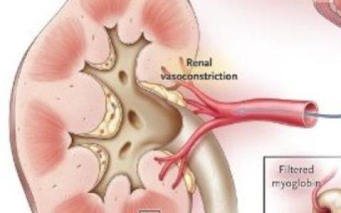NEJM: 横纹肌溶解与急性肾损伤