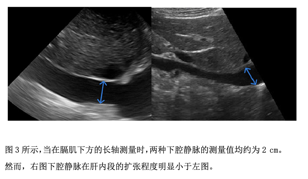 对于下腔静脉，吾等当知何事？