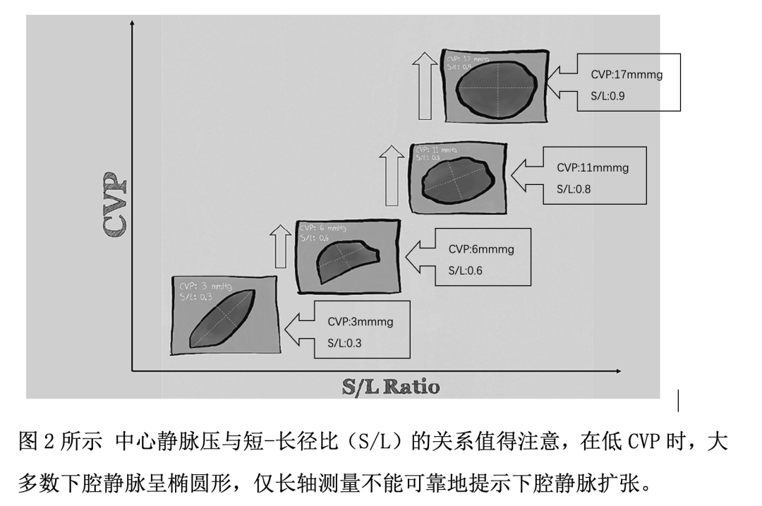 对于下腔静脉，吾等当知何事？
