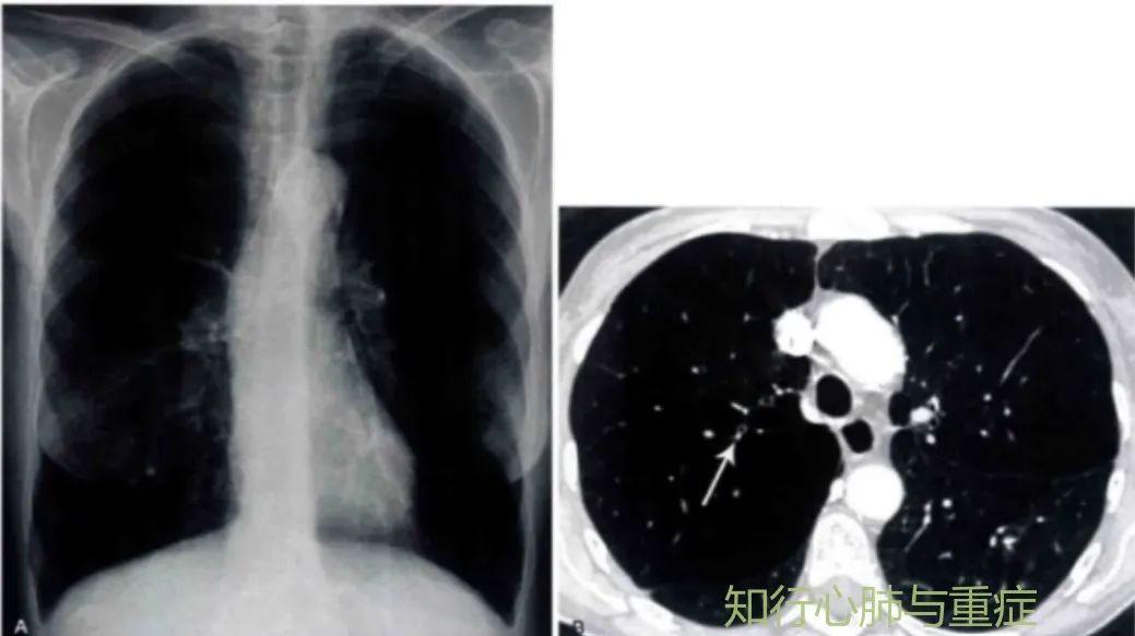 肺动脉高压的定义、分类及病理生理学机制