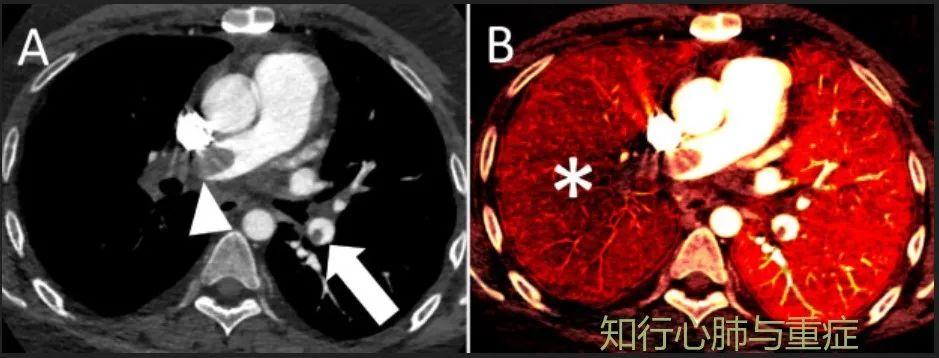肺动脉高压的定义、分类及病理生理学机制