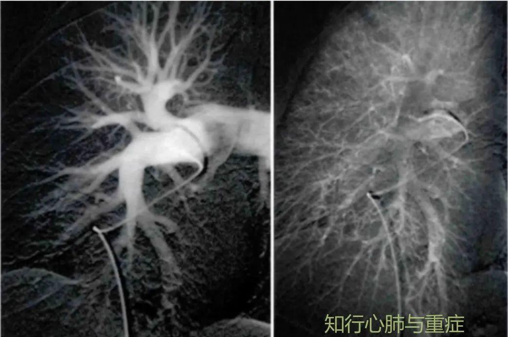 肺动脉高压的定义、分类及病理生理学机制