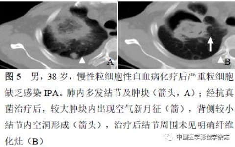 施毅教授：非粒缺患者侵袭性肺真菌病诊疗思路