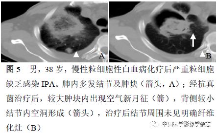 粒细胞缺乏和非粒细胞缺乏患者肺部侵袭性曲霉菌病的CT表现比较