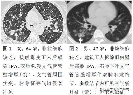 粒细胞缺乏和非粒细胞缺乏患者肺部侵袭性曲霉菌病的CT表现比较
