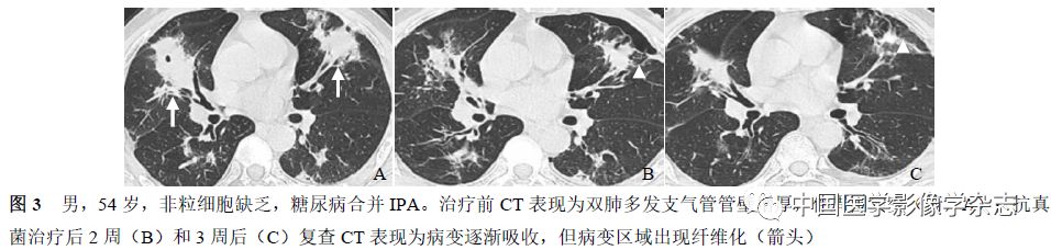粒细胞缺乏和非粒细胞缺乏患者肺部侵袭性曲霉菌病的CT表现比较