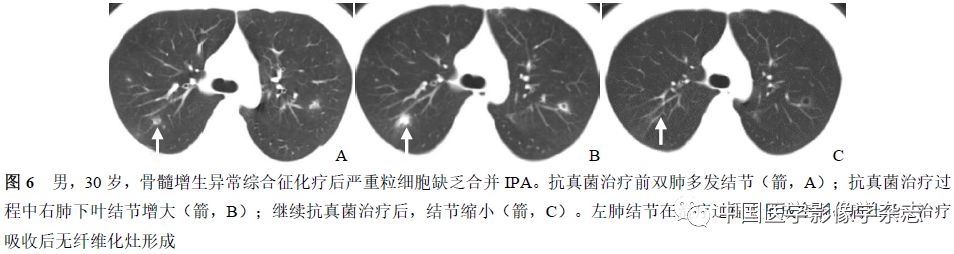 粒细胞缺乏和非粒细胞缺乏患者肺部侵袭性曲霉菌病的CT表现比较