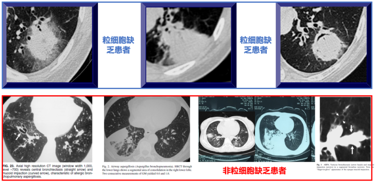 施毅教授:非粒缺患者侵袭性肺真菌病诊疗思路