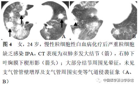 粒细胞缺乏和非粒细胞缺乏患者肺部侵袭性曲霉菌病的CT表现比较