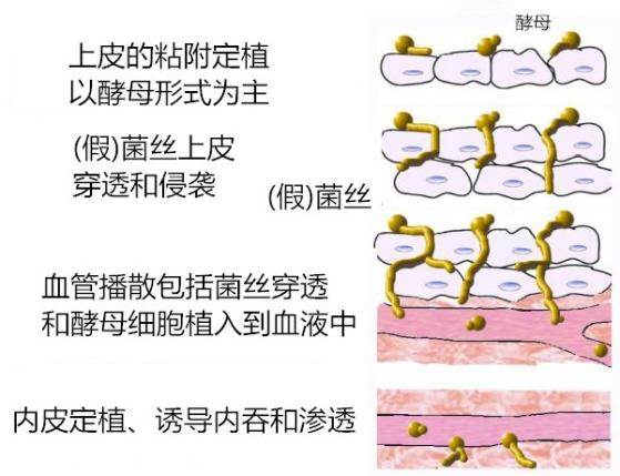 查到真菌，如何判定是定植还是感染？