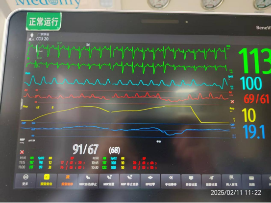 ECMO导管引流TACV术