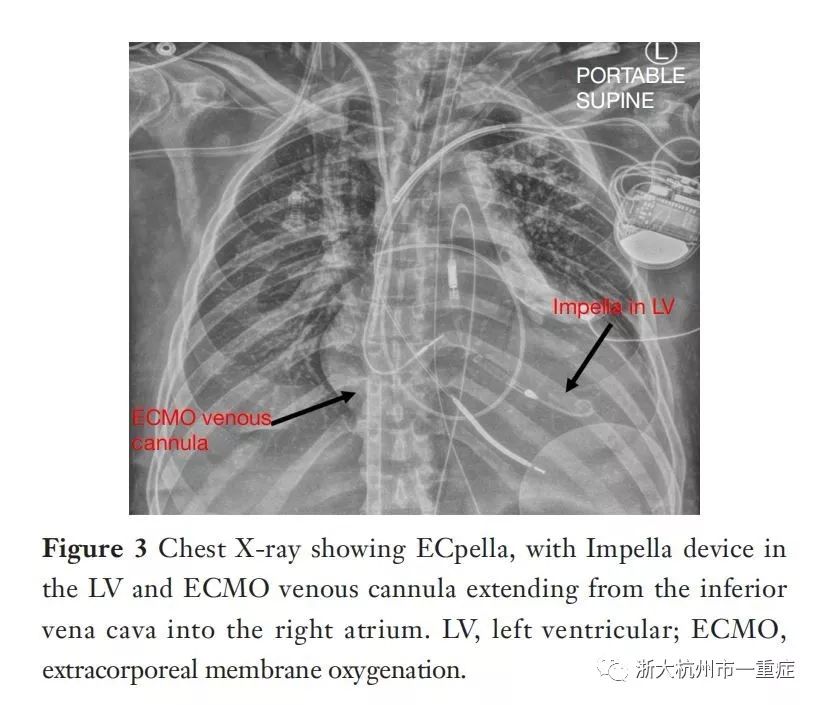 VA-ECMO患者左心室扩张VS减压策略