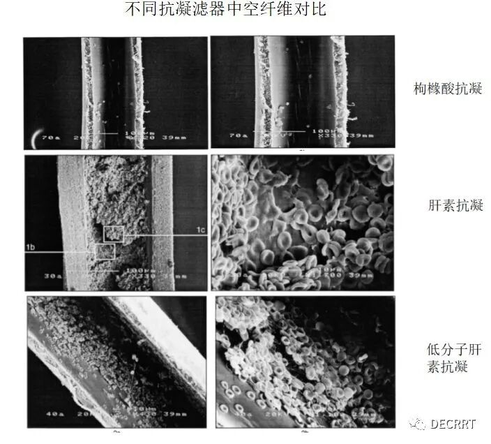 枸橼酸联合低分子抗凝下的CRRT74小时