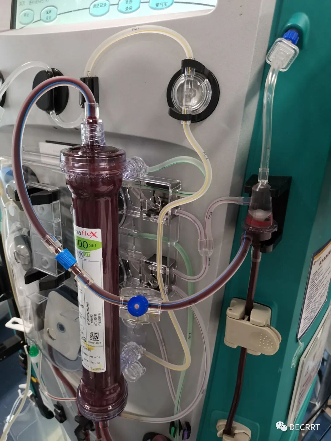 枸橼酸联合低分子抗凝下的CRRT74小时