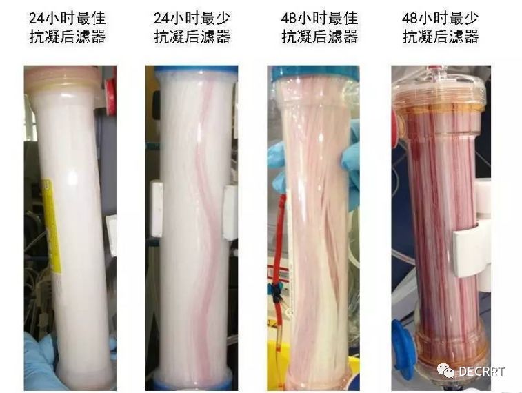 枸橼酸联合低分子抗凝下的CRRT74小时