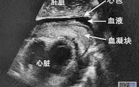 查房有感 · 一个腹痛伴低血压的病人血压 78/45，心率 128，乳酸 4.8。是感染？是出血？是心衰？年轻医生站在床边不知道先干哪件事｜休克