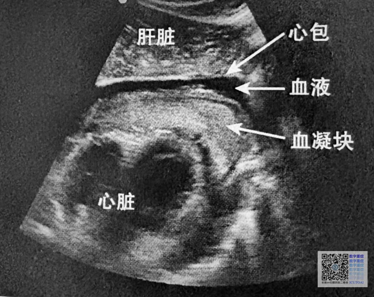 查房有感 · 一个腹痛伴低血压的病人血压 78/45,心率 128,乳酸 4.8。是感染?是出血?是心衰?年轻医生站在床边不知道先干哪件事|休克
